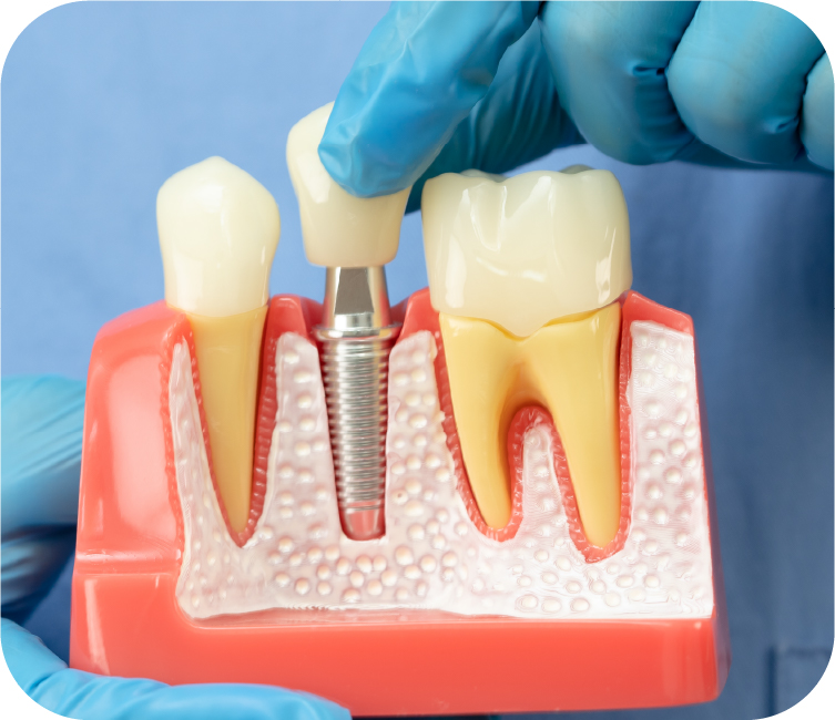 Implant (Trồng răng)