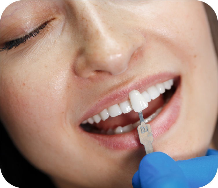 Veneers (Porcelain Veneers)