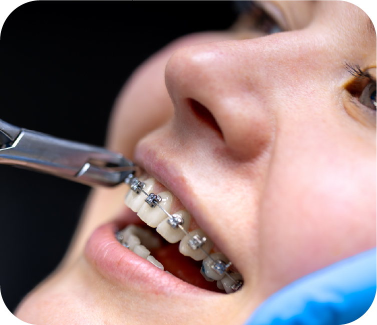 Orthodontics (Braces)